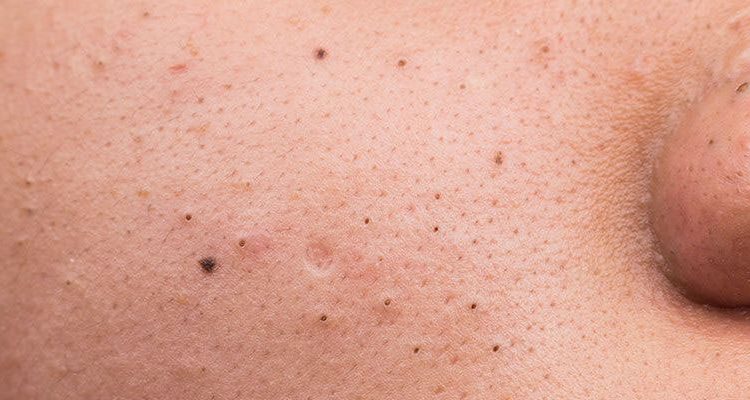 Eliminate Blackheads